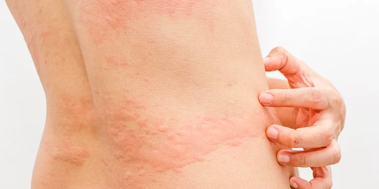 Bác sĩ bật mí cách để kiểm soát mày đay mạn tính