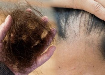 Rụng tóc toàn bộ và rụng tóc toàn thể