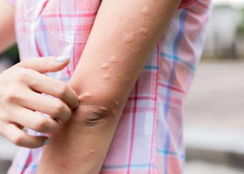 Các nguyên nhân thường gặp của bệnh mày đay mạn tính