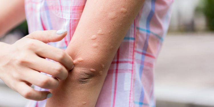 Các nguyên nhân thường gặp của bệnh mày đay mạn tính