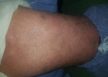 Sai lầm trong điều trị bệnh Vảy nến có nguy cơ mắc ung thư da?