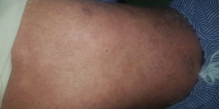 Sai lầm trong điều trị bệnh Vảy nến có nguy cơ mắc ung thư da?