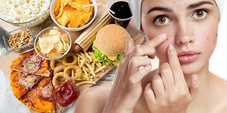 Ảnh hưởng của chế độ ăn với bệnh trứng cá