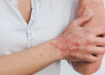 Cập nhật điều trị vảy nến trên bệnh nhân nhiễm virus viêm gan B, C