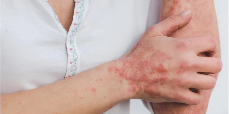 Cập nhật điều trị vảy nến trên bệnh nhân nhiễm virus viêm gan B, C