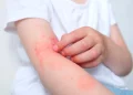 Bệnh viêm da cơ địa (Atopic Dermatitis-AD)