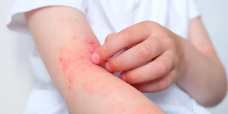 Bệnh viêm da cơ địa (Atopic Dermatitis-AD)