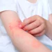 Bệnh viêm da cơ địa (Atopic Dermatitis-AD)