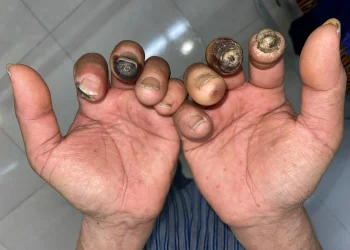 Những điều cần biết về bệnh xơ cứng bì