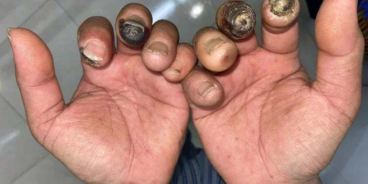 Những điều cần biết về bệnh xơ cứng bì