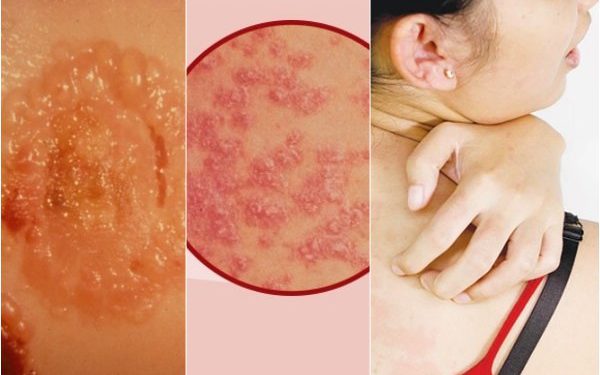Lời khuyên cho bệnh nhân Pemphigus