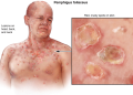 Pemphigus: Dấu hiệu, nguyên nhân và cách điều trị