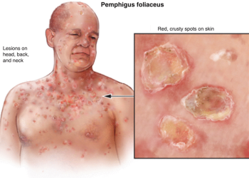 Pemphigus: Dấu hiệu, nguyên nhân và cách điều trị