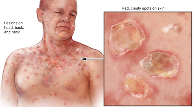 Pemphigus: Dấu hiệu, nguyên nhân và cách điều trị