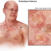 Pemphigus: Dấu hiệu, nguyên nhân và cách điều trị