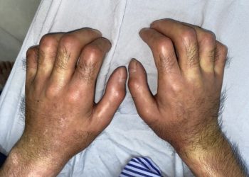 Các biện pháp cải thiện chất lượng cuộc sống cho bệnh nhân xơ cứng bì