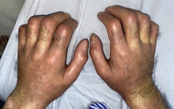 Các biện pháp cải thiện chất lượng cuộc sống cho bệnh nhân xơ cứng bì