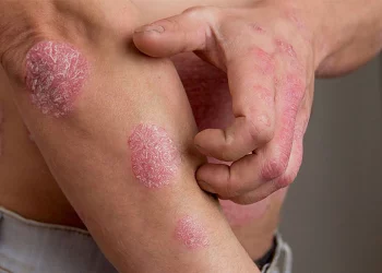 Cập nhật điều trị vảy nến trên bệnh nhân HIV