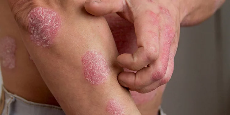 Cập nhật điều trị vảy nến trên bệnh nhân HIV