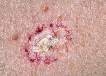 Đa bowen (ung thư biểu mô tế bào vảy) và mối liên quan với thạch tín