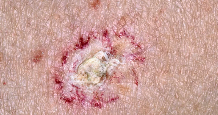 Đa bowen (ung thư biểu mô tế bào vảy) và mối liên quan với thạch tín