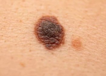 Dấu hiệu nhận biết nốt ruồi ác tính