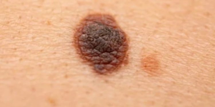 Dấu hiệu nhận biết nốt ruồi ác tính