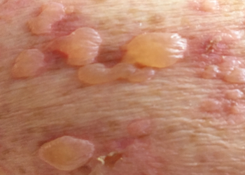 Lời khuyên cho bệnh nhân Pemphigoid