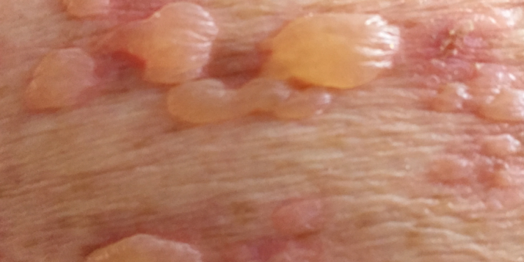 Lời khuyên cho bệnh nhân Pemphigoid