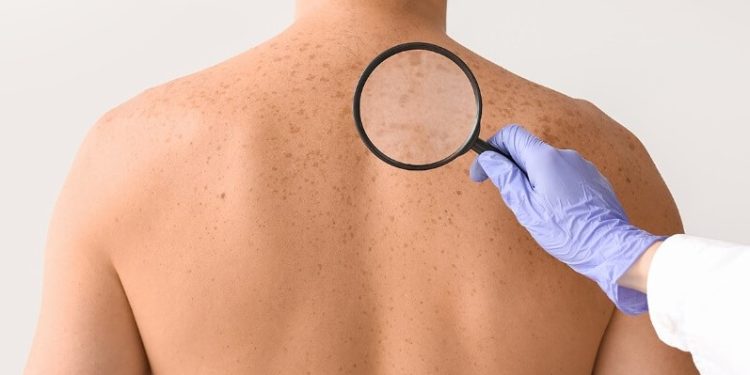 Cách phòng ngừa ung thư da