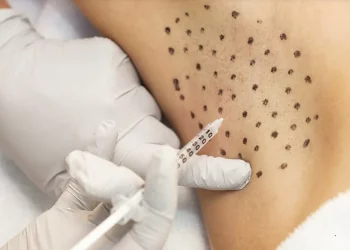 Điều trị tăng tiết mồ hôi bằng Botulinum Toxin