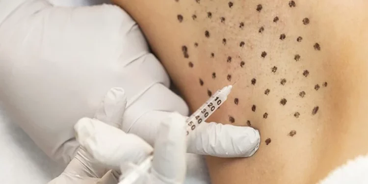 Điều trị tăng tiết mồ hôi bằng Botulinum Toxin
