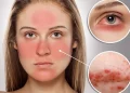 Tóm tắt những điều cần biết về bệnh lupus ban đỏ hệ thống