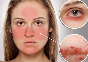 Tóm tắt những điều cần biết về bệnh lupus ban đỏ hệ thống