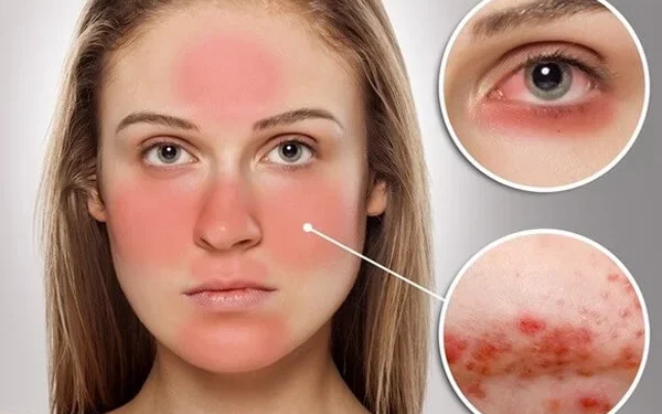 Tóm tắt những điều cần biết về bệnh lupus ban đỏ hệ thống