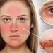 Tóm tắt những điều cần biết về bệnh lupus ban đỏ hệ thống