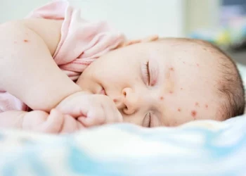 Phòng ngừa bệnh da nhiễm khuẩn ở trẻ em