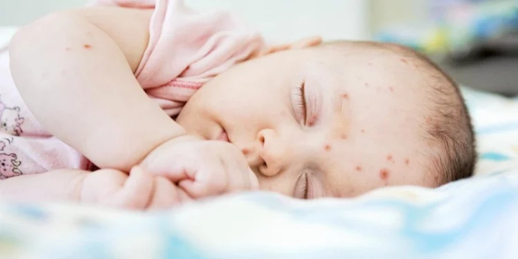 Phòng ngừa bệnh da nhiễm khuẩn ở trẻ em