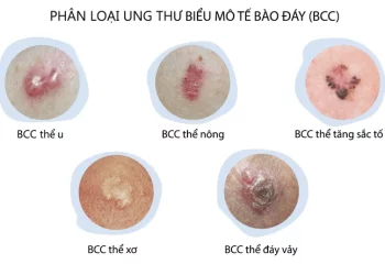 Ung thư da và những điều cần biết