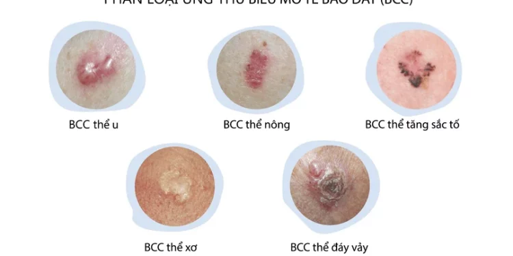 Ung thư da và những điều cần biết