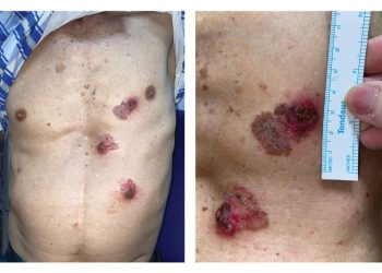 Đa ung thư tế bào vảy ở da có liên quan đến việc sử dụng thạch tín (arsenic)