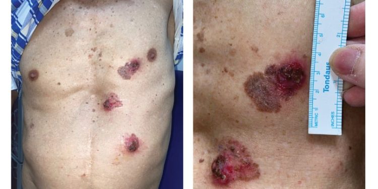 Đa ung thư tế bào vảy ở da có liên quan đến việc sử dụng thạch tín (arsenic)