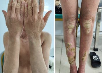 Hội chứng Keratitis–Ichthyosis–Deafness (K.I.D): Bệnh da liễu di truyền hiếm gặp