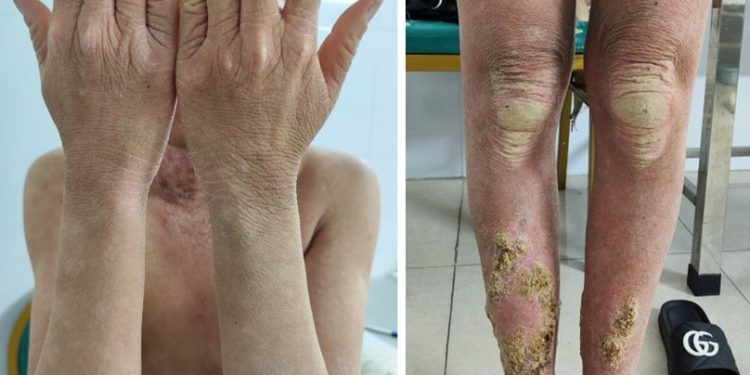 Hội chứng Keratitis–Ichthyosis–Deafness (K.I.D): Bệnh da liễu di truyền hiếm gặp