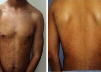 Giảm sắc tố dạng dát tiến triển (Progressive macular hypomelanosis)