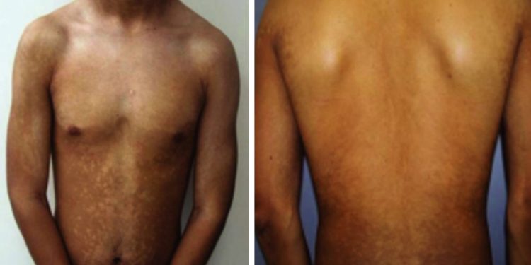 Giảm sắc tố dạng dát tiến triển (Progressive macular hypomelanosis)