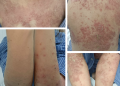 Vảy nến mủ ở phụ nữ có thai (Pustular psoriasis of pregnancy)
