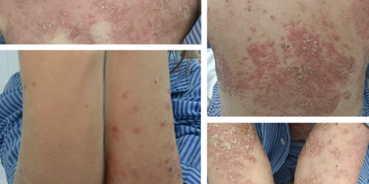 Vảy nến mủ ở phụ nữ có thai (Pustular psoriasis of pregnancy)