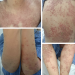 Vảy nến mủ ở phụ nữ có thai (Pustular psoriasis of pregnancy)