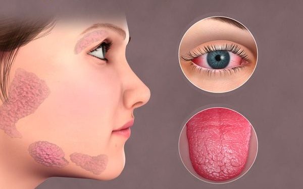 Bệnh Sjogren (Sjogren’s disease)